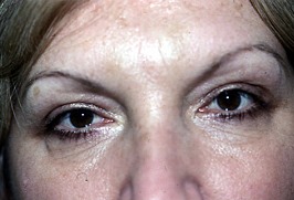 After Eyelid Rejuvenation