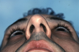 Before Surgery