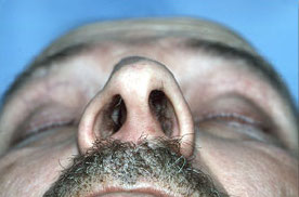 Before Surgery