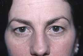 Before Eyelid Rejuvenation