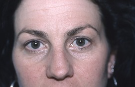 After Eyelid Rejuvenation