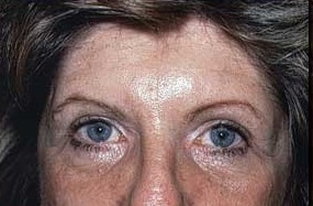 After Eyelid Rejuvenation