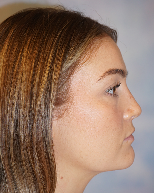 riverside-face-female-rhinoplasty-side-profile-after2034B75E-F800-D61E-4392-B69870CBCE1B.png