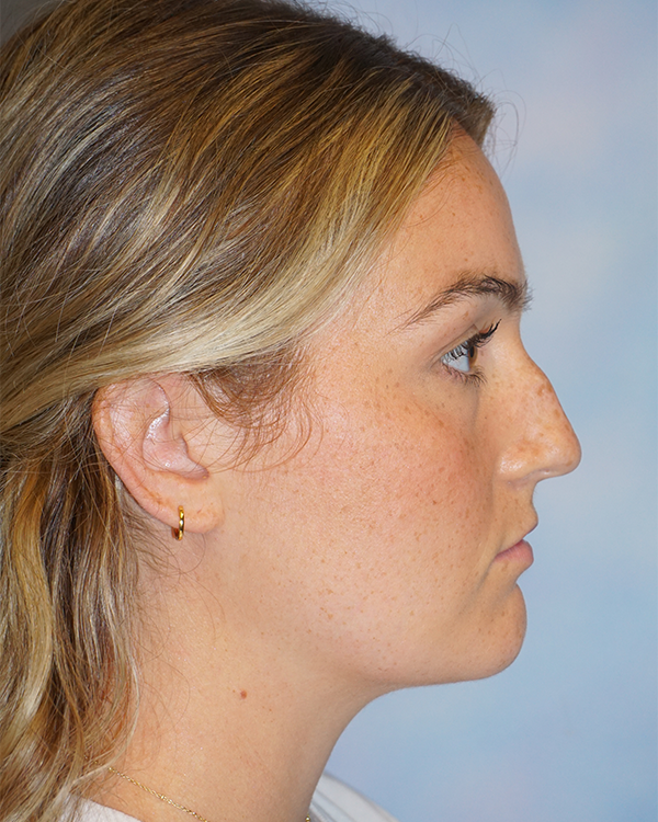 riverside-face-female-rhinoplasty-side-profile-before4B0E3FF8-07D4-2EED-A8CB-E62F84034960.png