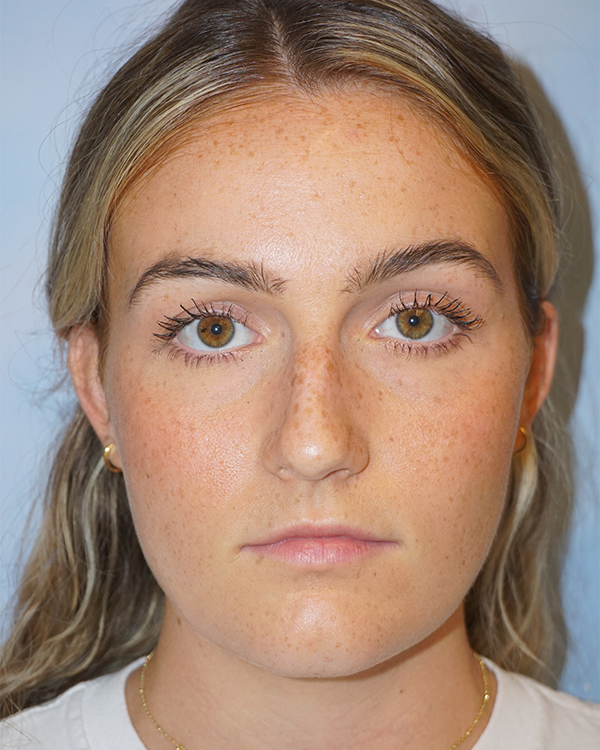 riverside-face-female-rhinoplasty62D0E1E7-5547-2CFB-DBCB-23DCD4BB0A34.png