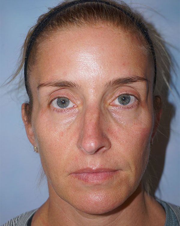 female-rhinoplasty-front-1BC2E56A5-8ED5-06BD-42B4-A034A40AEB41.jpg