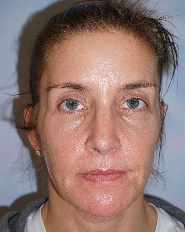 female-rhinoplasty-front-268755050-0259-313E-69C2-CC62A1634048.jpg