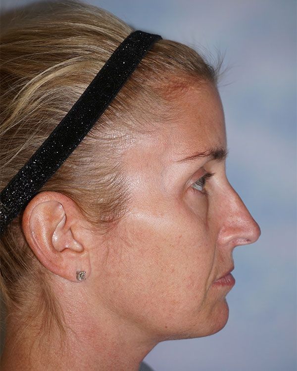 female-rhinoplasty-side-1BA8AC7B0-E129-2009-7550-C1D90C58289C.jpg