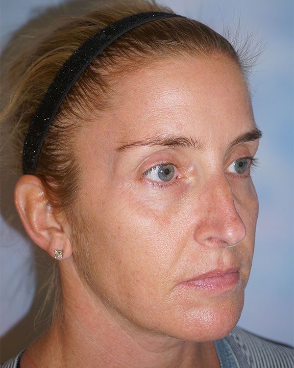 female-rhinoplasty-sidefront-19CA3DC02-ABB1-6E6A-1C24-B84D328FDE39.jpg