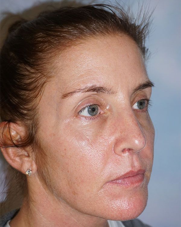 female-rhinoplasty-sidefront-2118C1DBF-C6BC-7AF7-5954-194147E4EB20.jpg