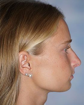 before-side2CD8D523-35B1-999E-B2ED-E162CE50DB30.jpg