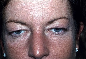 Before Eyelid Rejuvenation