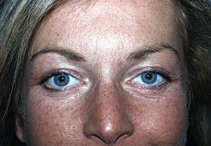 After Eyelid Rejuvenation