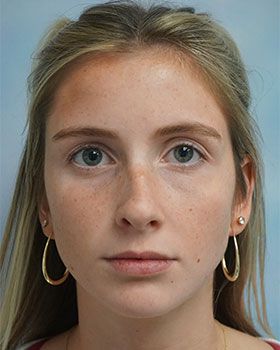 before-frontB296FAF9-FEC2-C9E2-AF0C-34A1444454FF.jpg