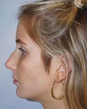 before-sideB90CEA36-C918-ED37-ABAE-16D5C40A770A.jpg
