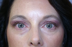 After Eyelid Rejuvenation