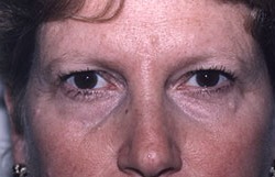 Before Eyelid Rejuvenation