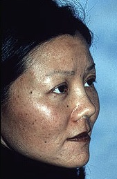 After Eyelid Rejuvenation