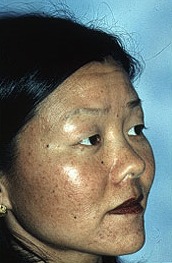 Before Eyelid Rejuvenation