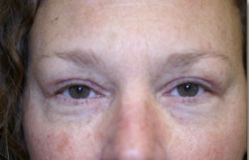 After Eyelid Rejuvenation