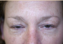 Before Eyelid Rejuvenation