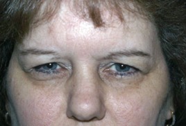 Before Eyelid Rejuvenation