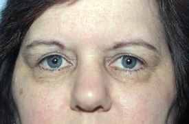 After Eyelid Rejuvenation