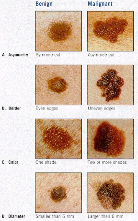 different types of mole