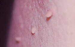 skin tags