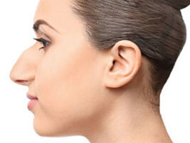 rhinoplasty featured