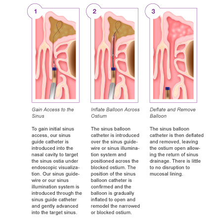 sinus diagram